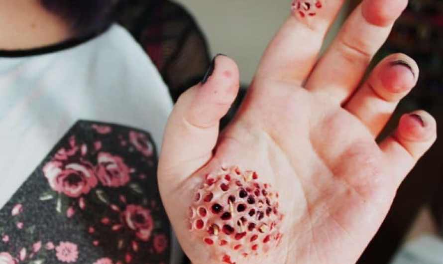 Trypophobia (Fear Of Holes On Skin)